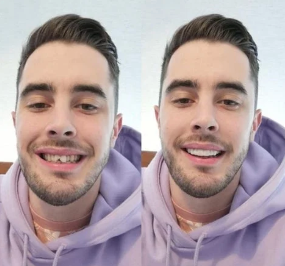Carillas Dentales Moldeables - Paquete 2x1 (Recibes 2)