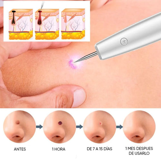 🔥 Lápiz Cauterizador Estético — Elimina Verrugas desde Casa