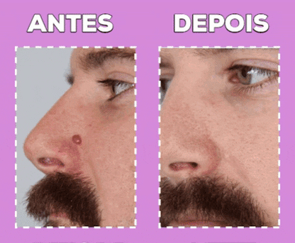 🔥 Lápiz Cauterizador Estético — Elimina Verrugas desde Casa