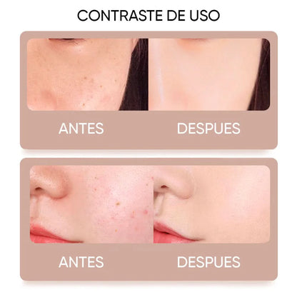 🔥 Lápiz Cauterizador Estético — Elimina Verrugas desde Casa