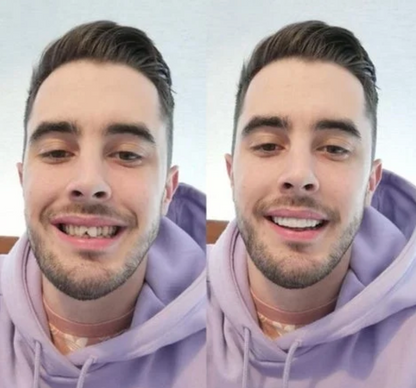 Carillas Dentales Moldeables - Paquete 2x1 (Recibes 2)